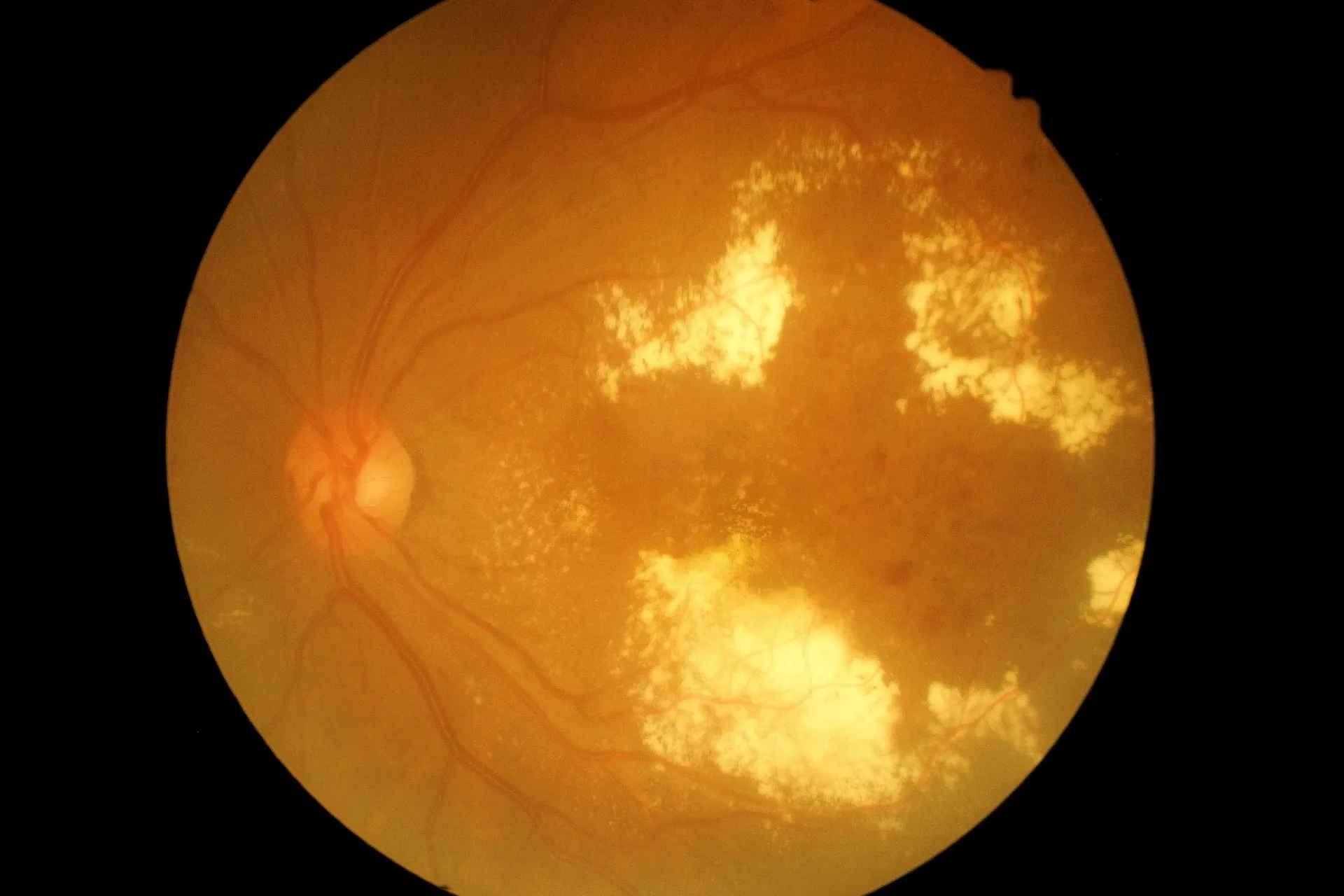 What is Diabetic Retinopathy