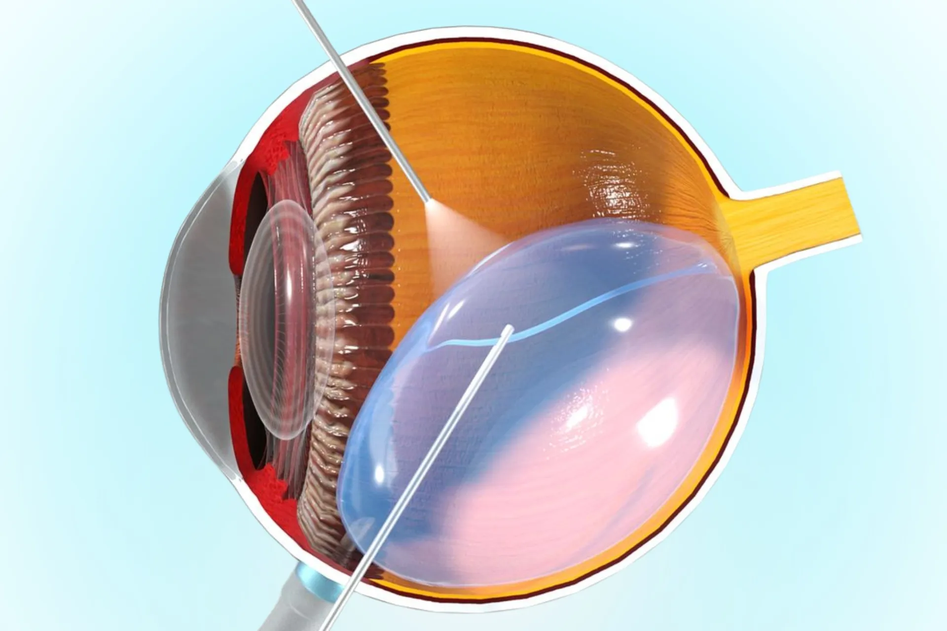 การผ่าตัดวุ้นตา (Vitrectomy) ในการรักษาโรคเบาหวานขึ้นจอตาขั้นรุนแรง