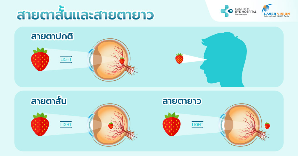 เช็กระดับสายตาสั้น รู้ทันความรุนแรงของอาการ