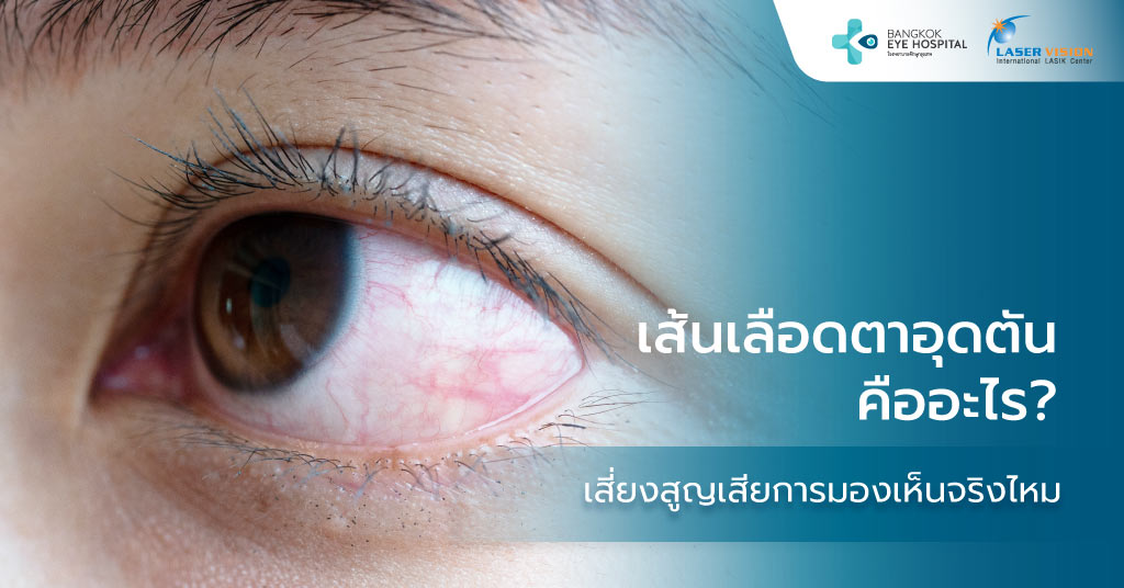 เส้นเลือดตาอุดตันคืออะไร? เสี่ยงสูญเสียการมองเห็นจริงไหม