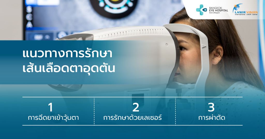 แนวทางการรักษาเส้นเลือดตาอุดตัน
