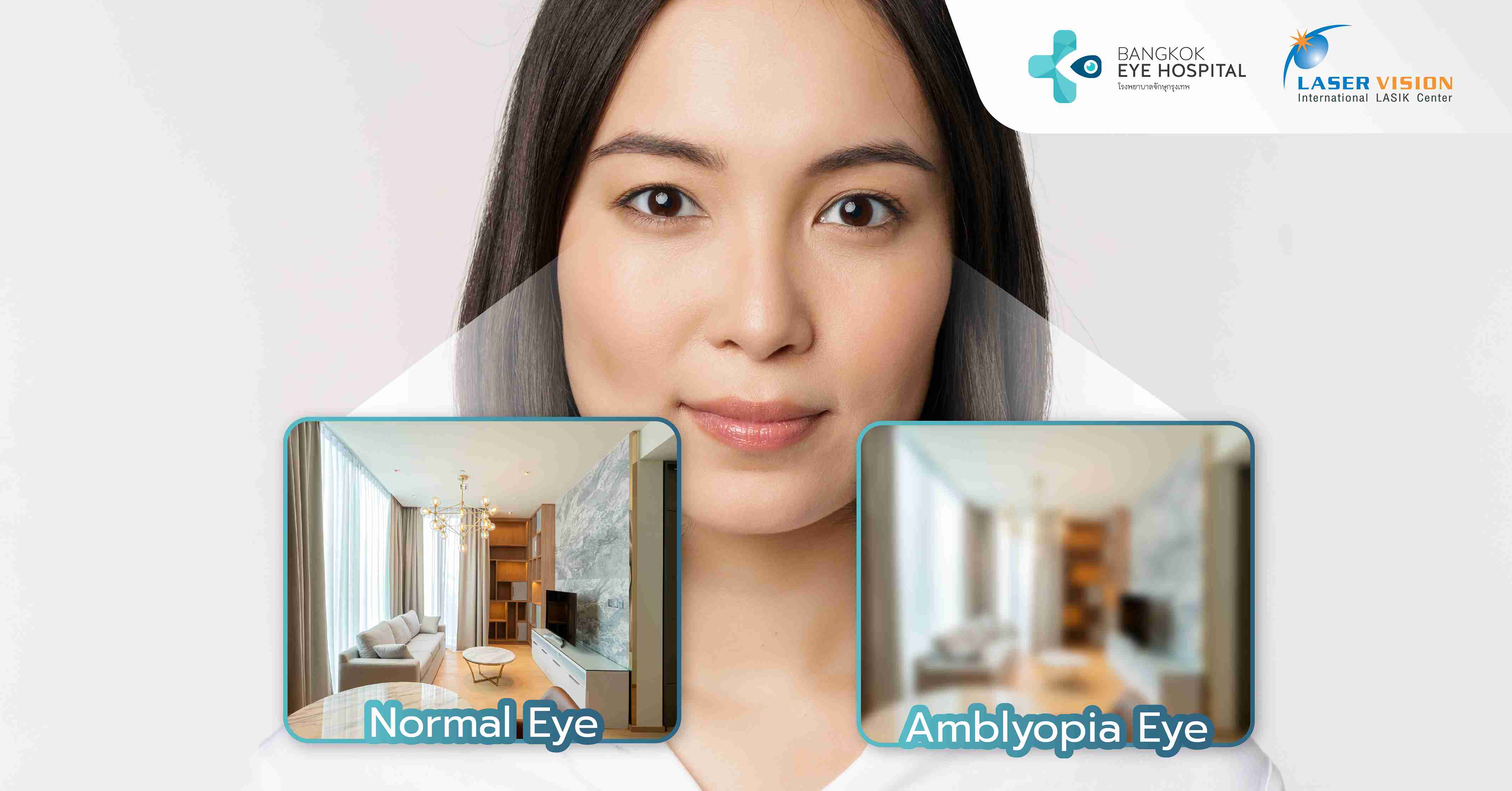 โรคตาขี้เกียจ (Amblyopia) คืออะไร