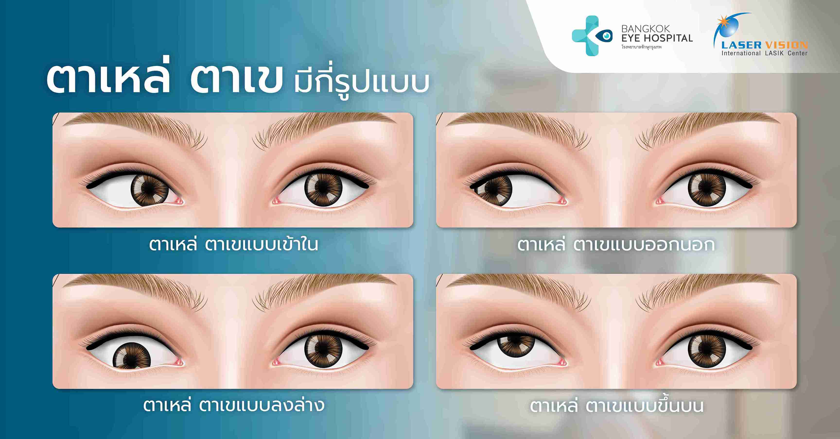 ตาเหล่ ตาเข มีกี่รูปแบบ