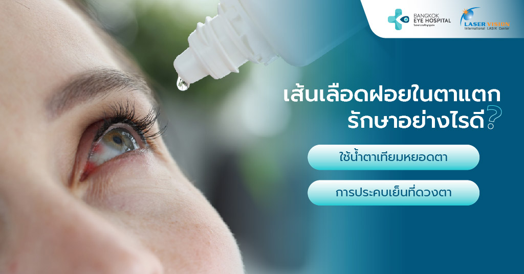 เส้นเลือดฝอยในตาแตกรักษาอย่างไรดี?
