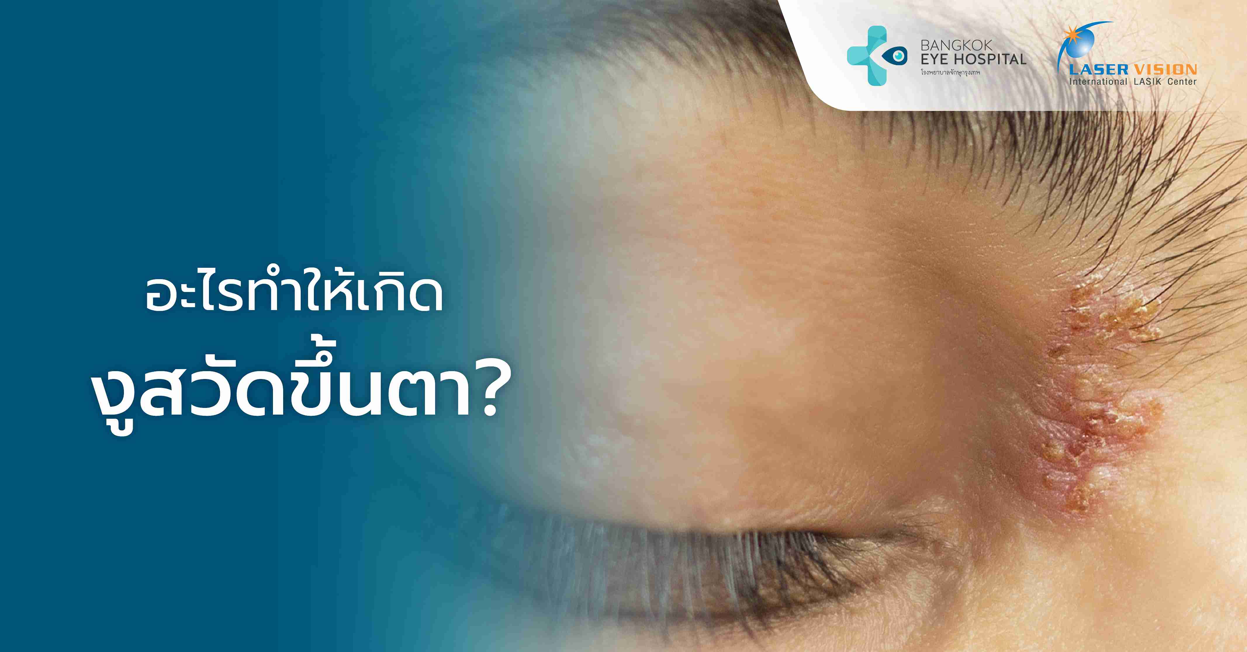 อะไรทำให้เกิดงูสวัดขึ้นตา?