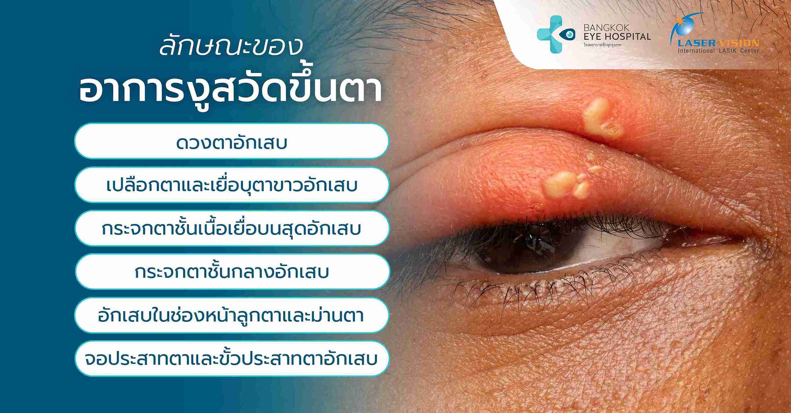 ลักษณะของอาการงูสวัดขึ้นตา