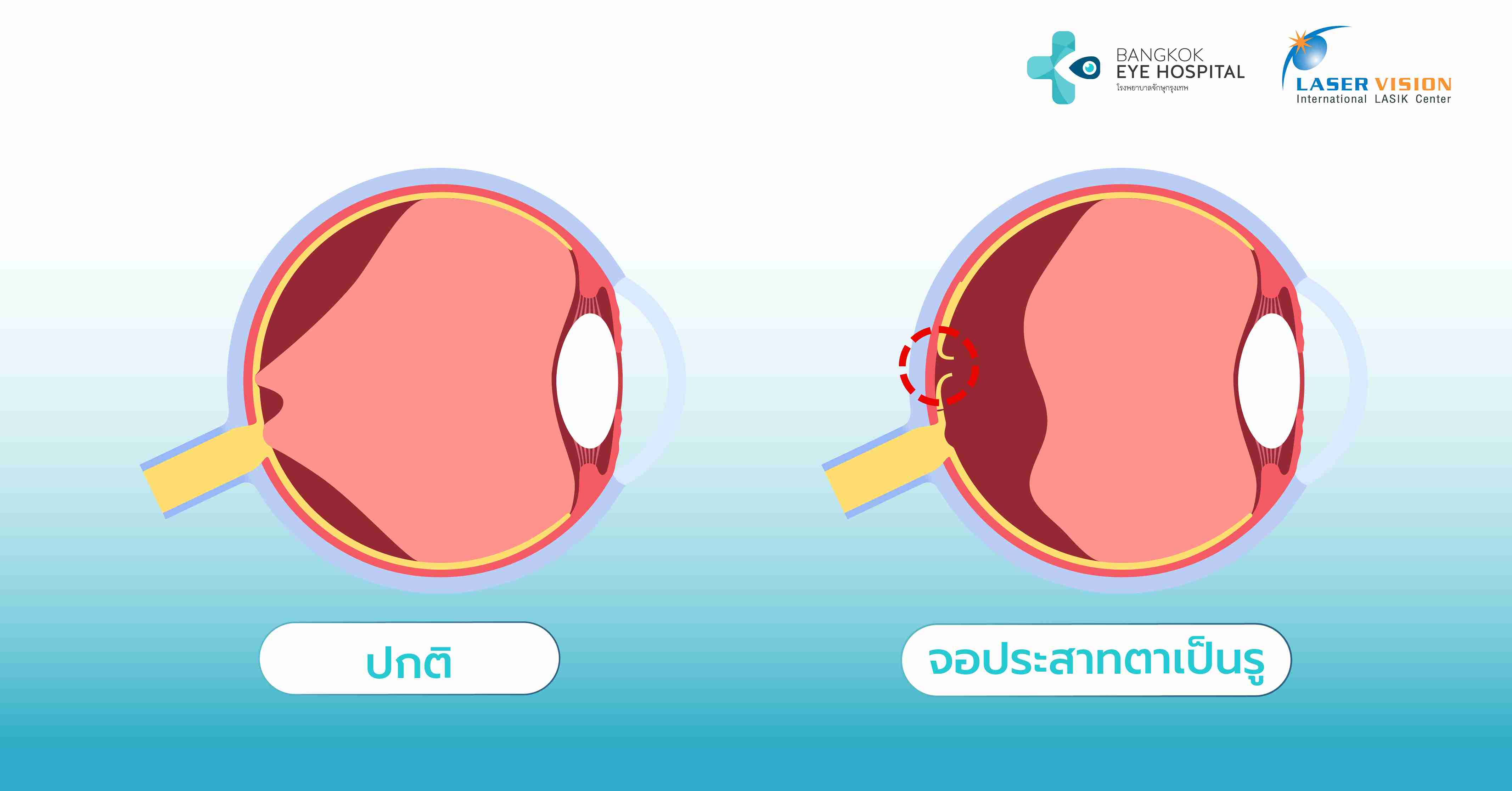 ภาวะจอประสาทตาเป็นรูคืออะไร?