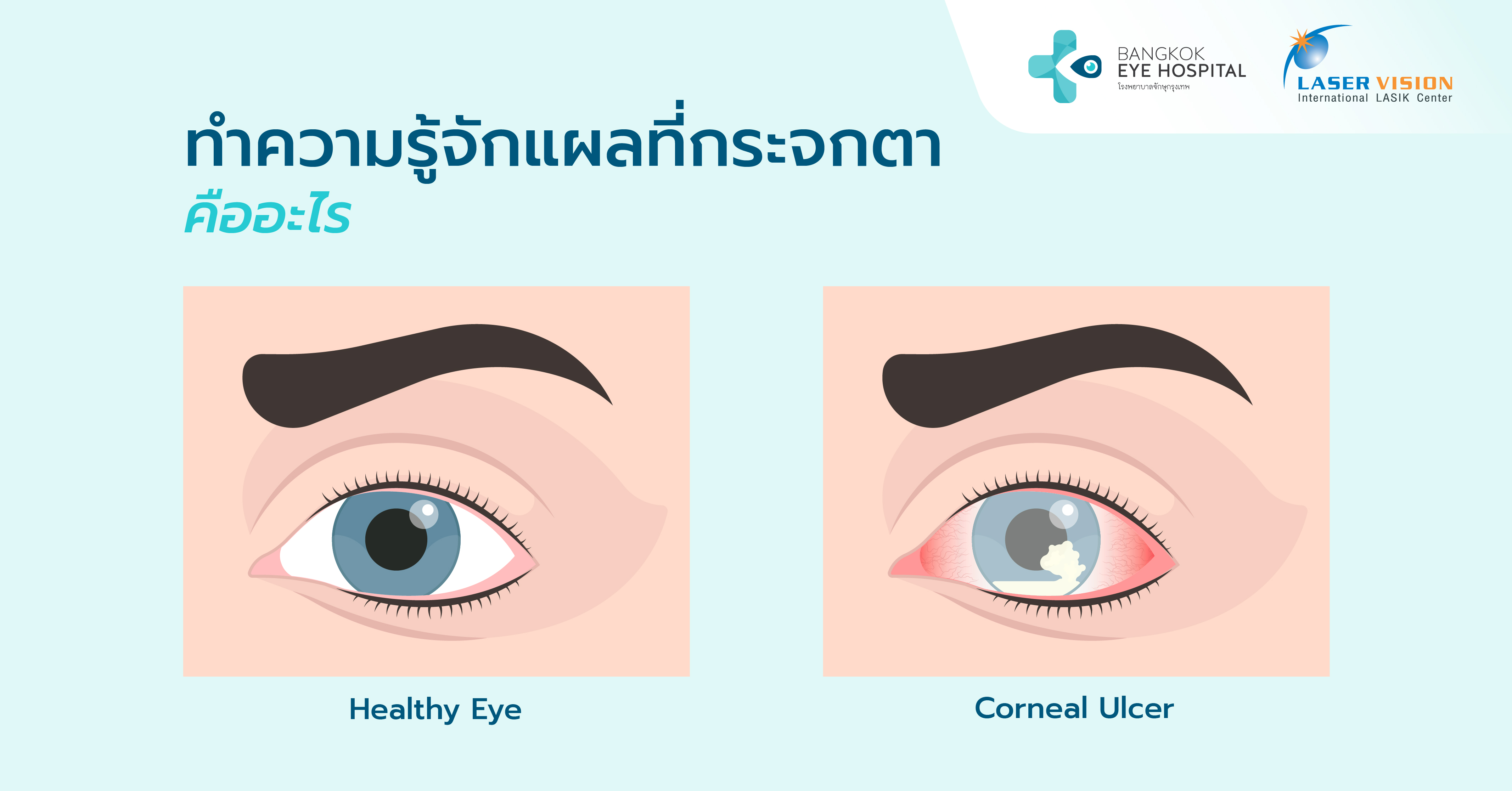 ทำความรู้จักแผลที่กระจกตา คืออะไร