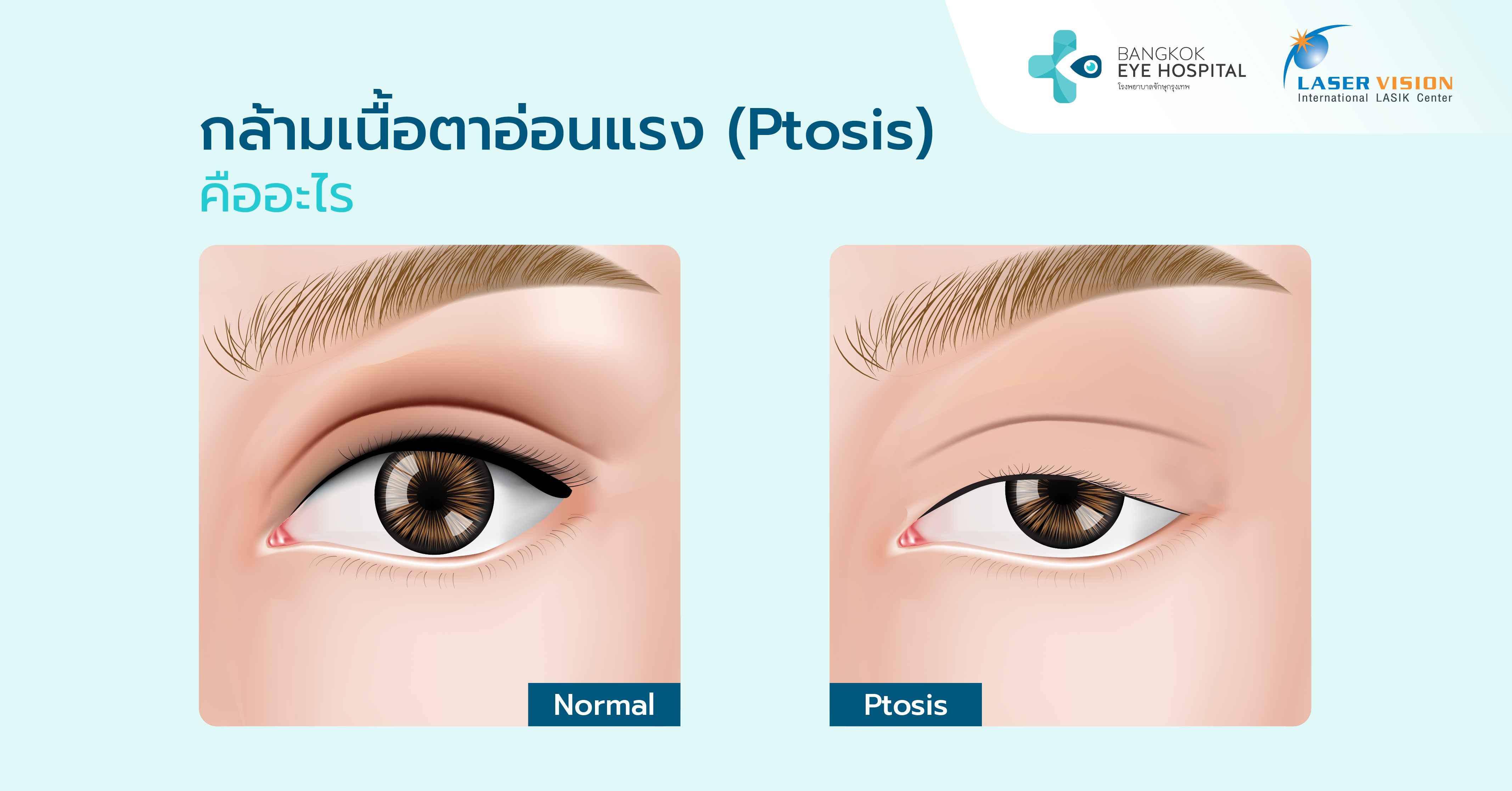 กล้ามเนื้อตาอ่อนแรง (Ptosis) คืออะไร