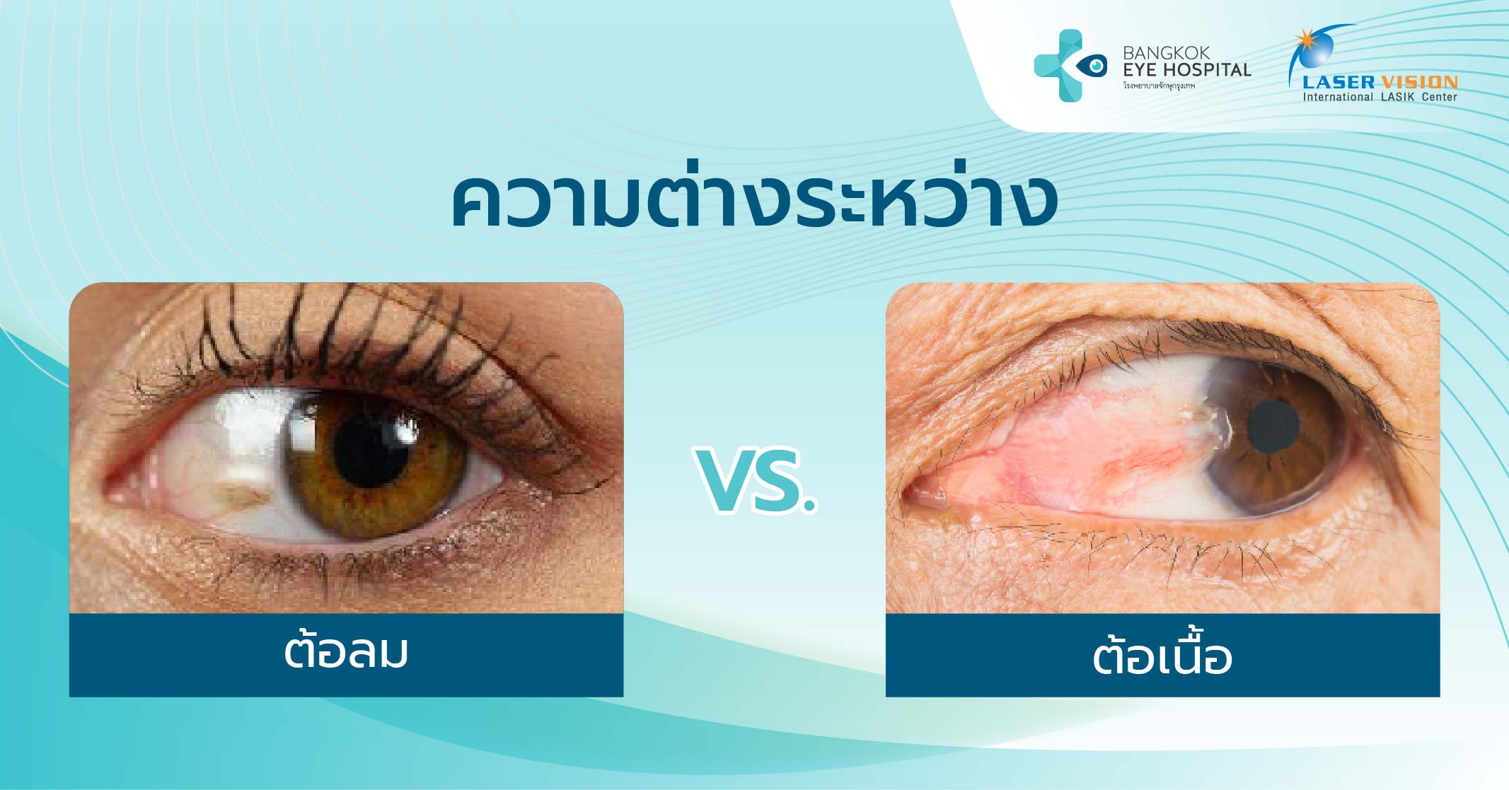 ความต่างระหว่างต้อลมและต้อเนื้อ