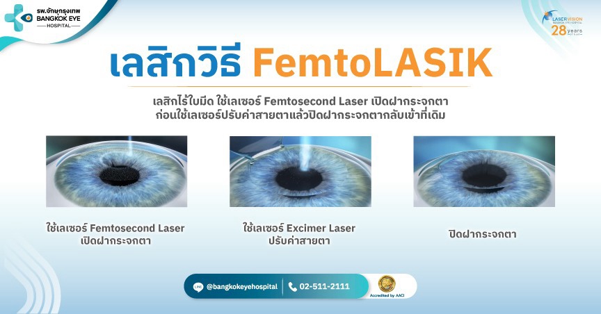 FemtoLASIK เลสิกไร้ใบมีดด้วย Femtosecond Laser