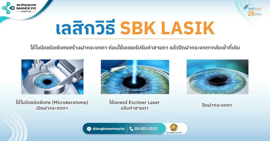 ภาพประกอบ SBK LASIK