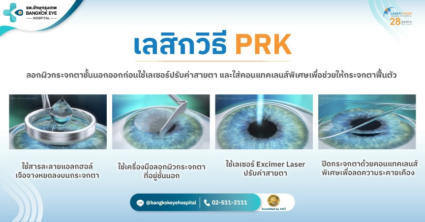 PRK laser vision correction procedure Illustration of the PRK laser vision correction procedure