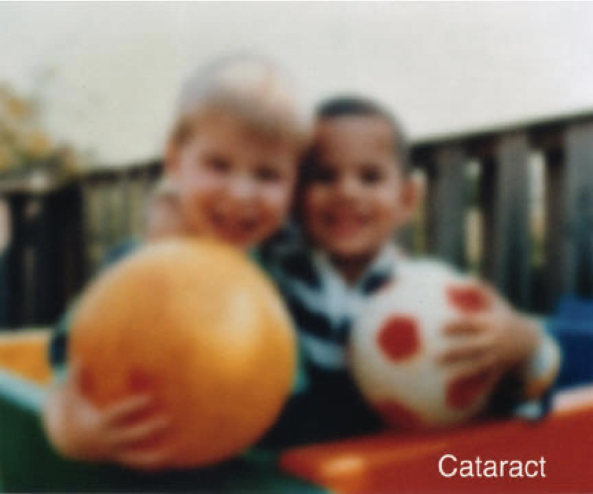 Cataract Vision