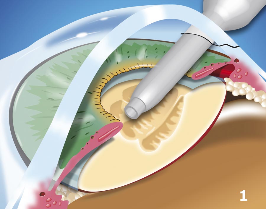 Phacoemulsification