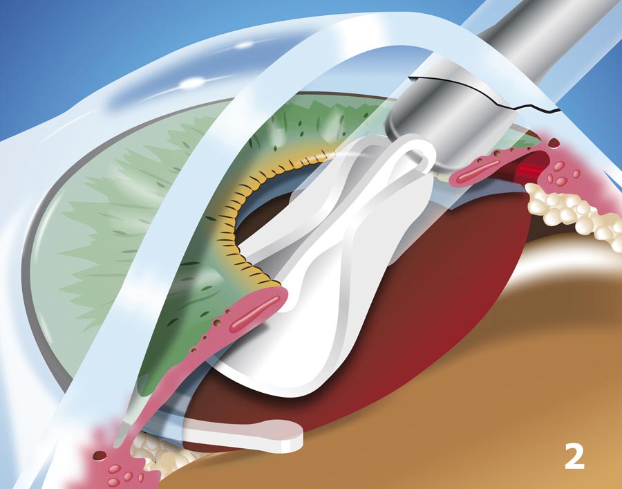 IOLs Insertion